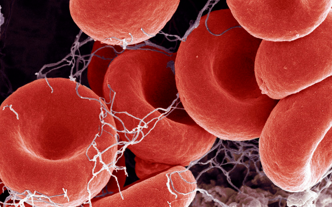 New Research Ties Rare Inflammatory Disease to Increased Risk of Cardiovascular Disease