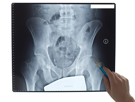  Femoroacetabular impingement (FAI)