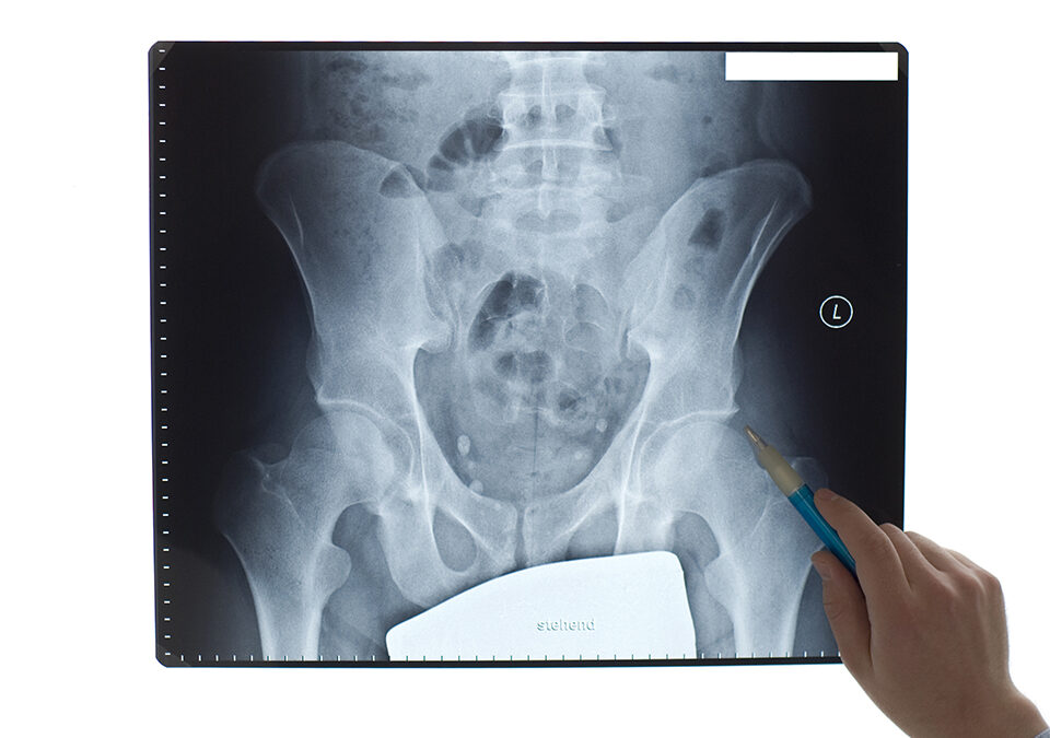 Alberta in Need of More Resources for Rural Residents with Osteoarthritis