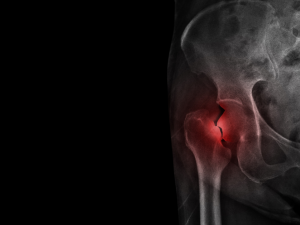 2025_Hip-Fractures-RA_Release-Feature-Image