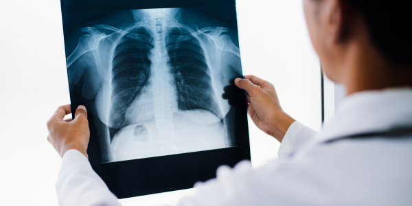 Scleroderma-Lung-Disease_PLS_Feature-Image