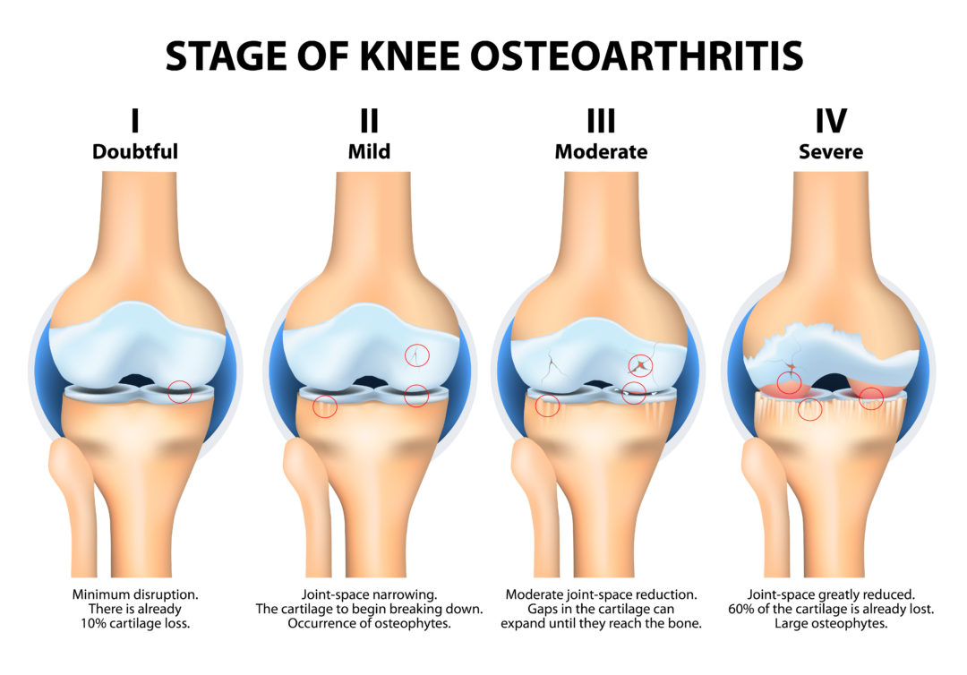 Degenerative stages of knee osteoarthritis Arthritis Research Canada